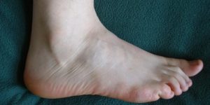 foot infections